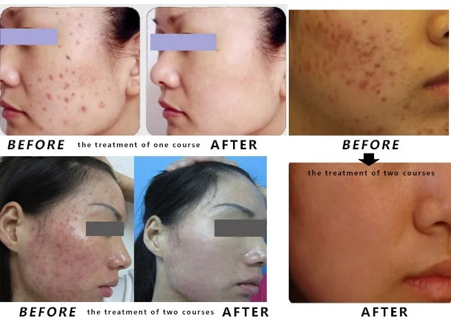 Photodynamic Therapy For Acne Treatment Beauty device