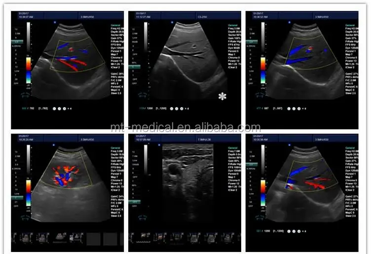 Medical Laptop Ultrasound Machine Color Ultrasound Scanner