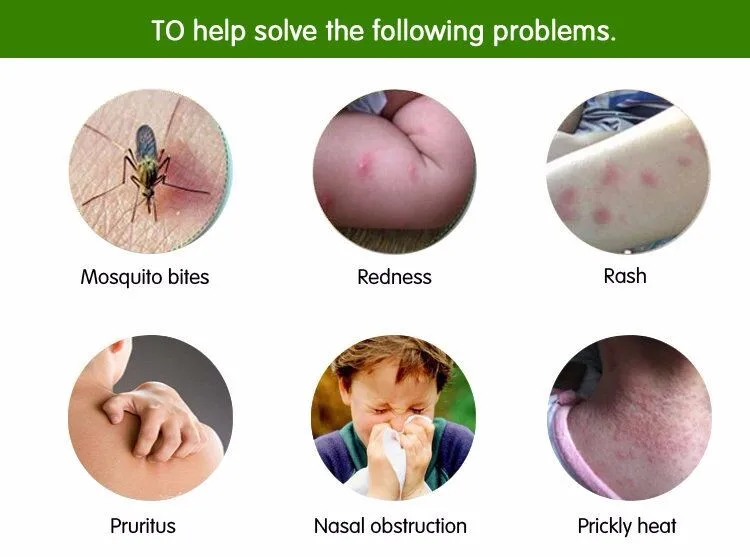 2018 Best Anti-Itch/Rash Cream Products anti-Itch Ointment for Mosquito Repellent Cream