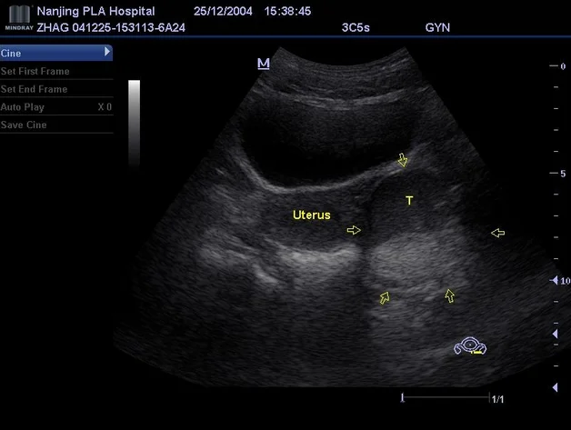Portable 3D Doppler Ultrasound Machine Ultrasonography
