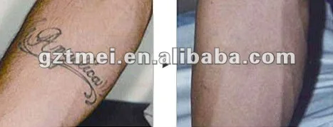 tattoo removal