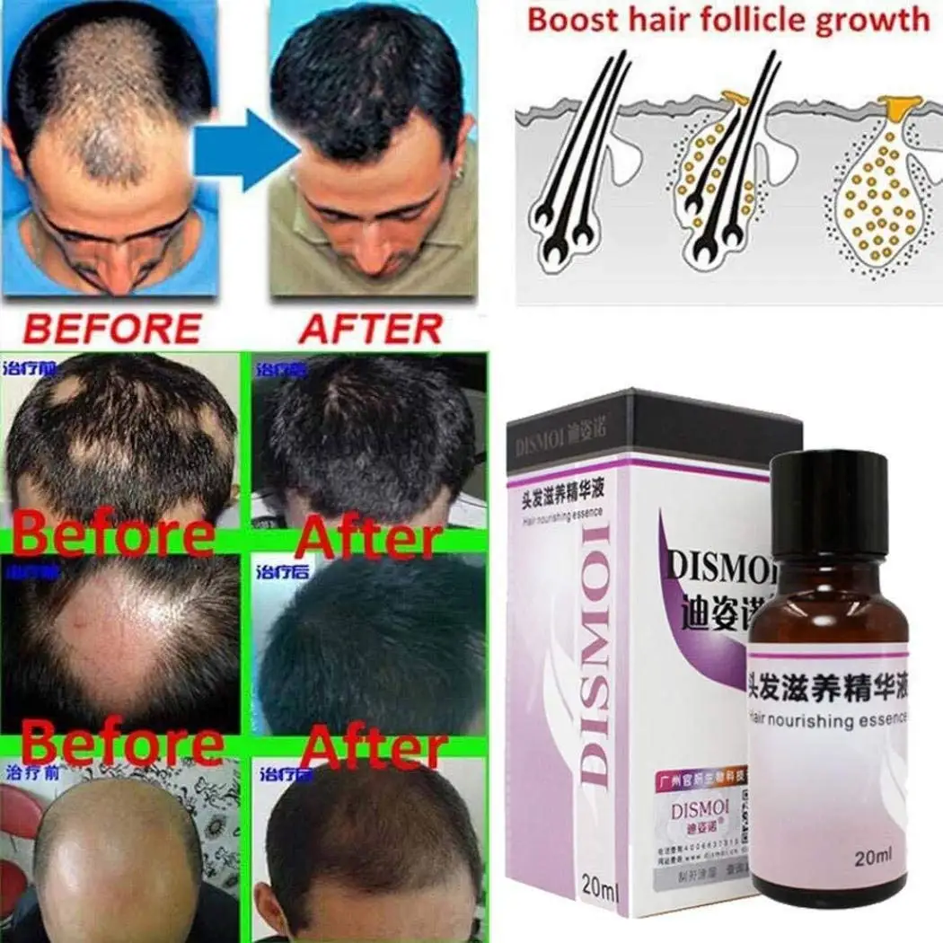 Cheap Best Hair Growth Treatment Find Best Hair Growth Treatment