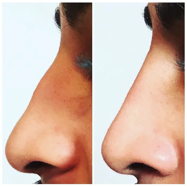 Non Surgical nosejob with dermal fillers for nose reshaping.jpg