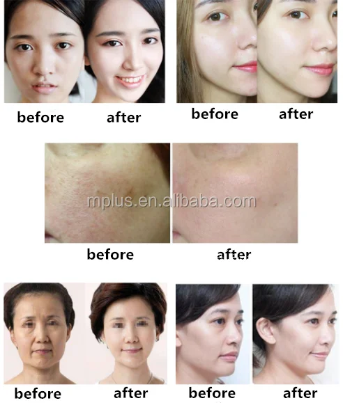 PDT&LED beauty mask face skin care laser facial rejuvenation machine
