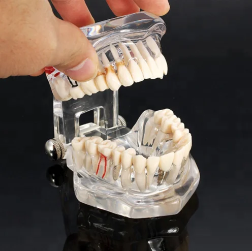 
Hot Sale Resin Dental Implant Model 