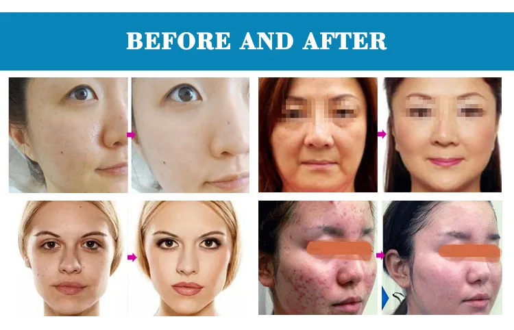 water dermabrasion machine