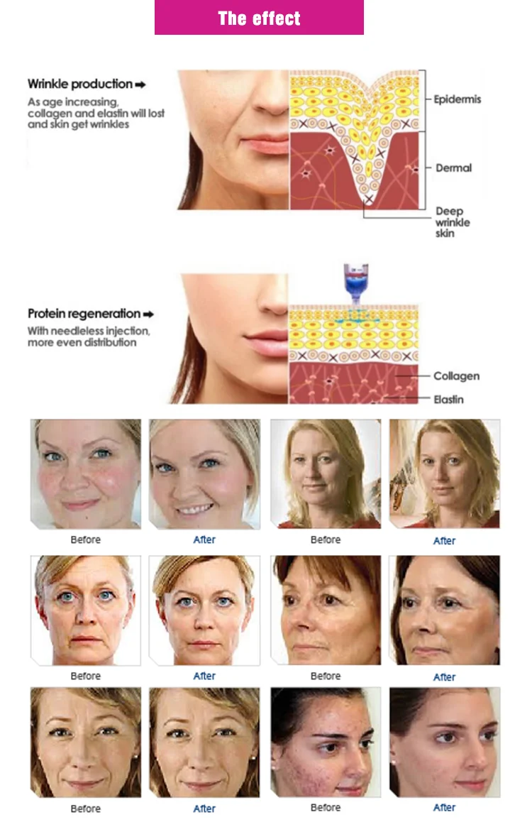 hyaluronic acid injector  pen.png