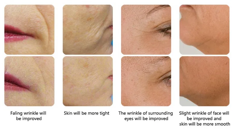 HONKON SIDEY Face Lift Skin Rejuvenation RF Wrinkles Removal Machine For Home Use