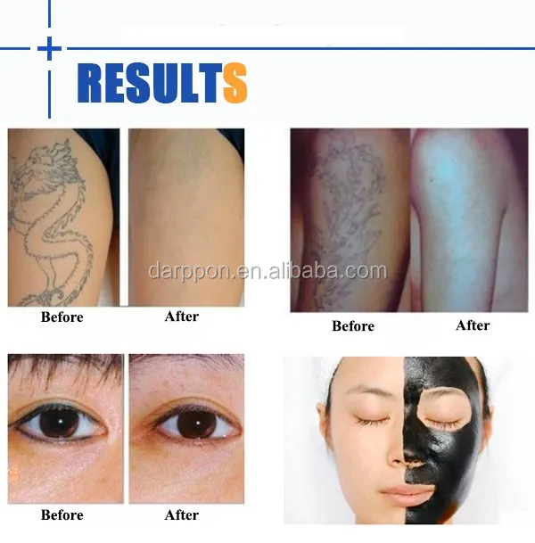 Nd Yag Laser Machine Dp-j158 For Spot/eyebrow Tattoo 