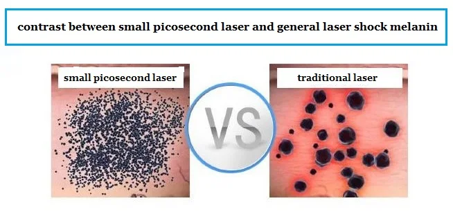 picosecond laser tattoo removal machine