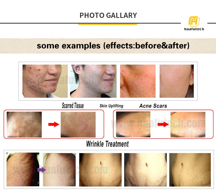 Newest Dr Pen X5 LED Screen Anti-aging Rechargeable Microneedling Derma Pen Cartridges for Sale