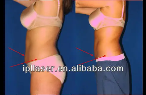 lipo waist 1