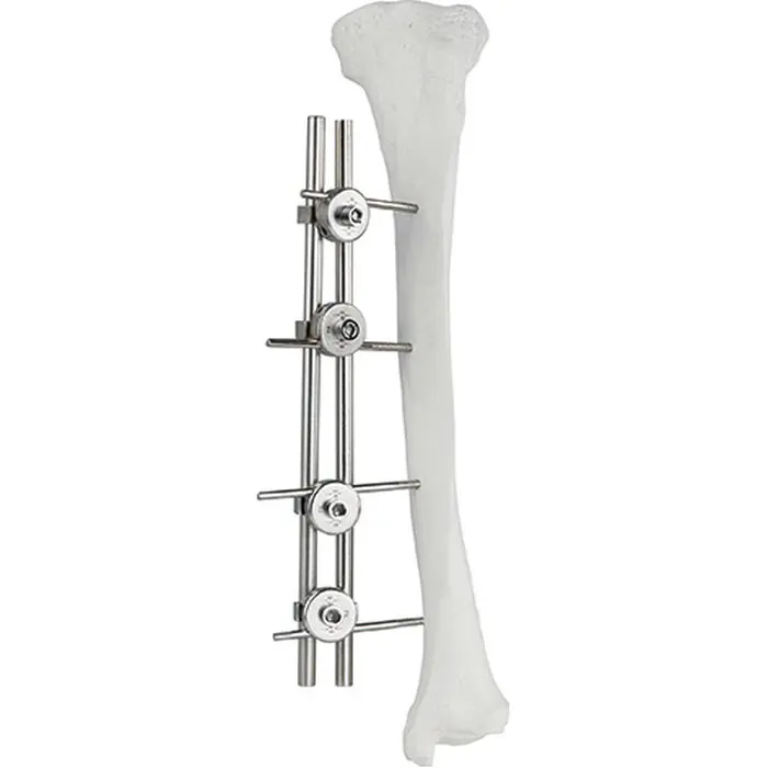 Guaranteed Quality Femur & Tibia External Fixator Surgical Implant