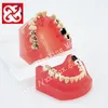 Caries treatment before and after comparison dental model with soft silicone gum with implant and fixed bridge