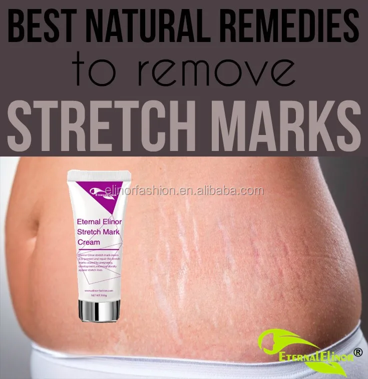 stretchmark14.jpg