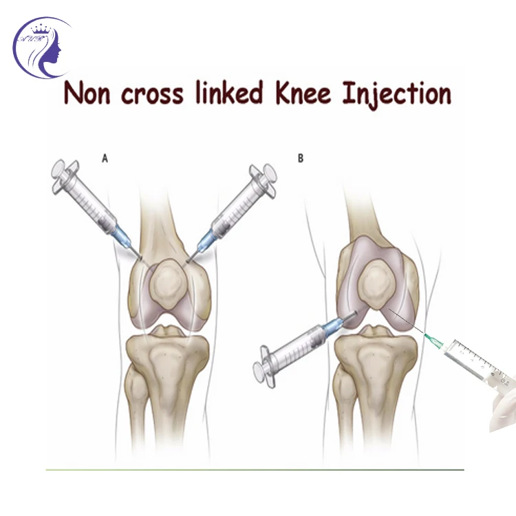 Gel Knee Osteoarthritis Collagen Hyaluronic Acid Knee Injection Buy Collagen Filler Injections