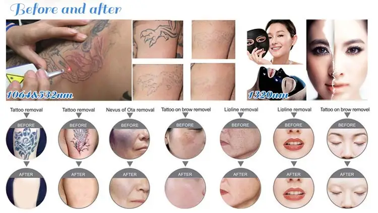 2020 newest Korea imported 532nm 1064nm 1320nm q switched nd yag laser for tattoo removal