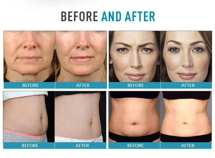 2018 newest V-max skin tightening portable ultrasound face lift effective wrinkle treatment machine for sale
