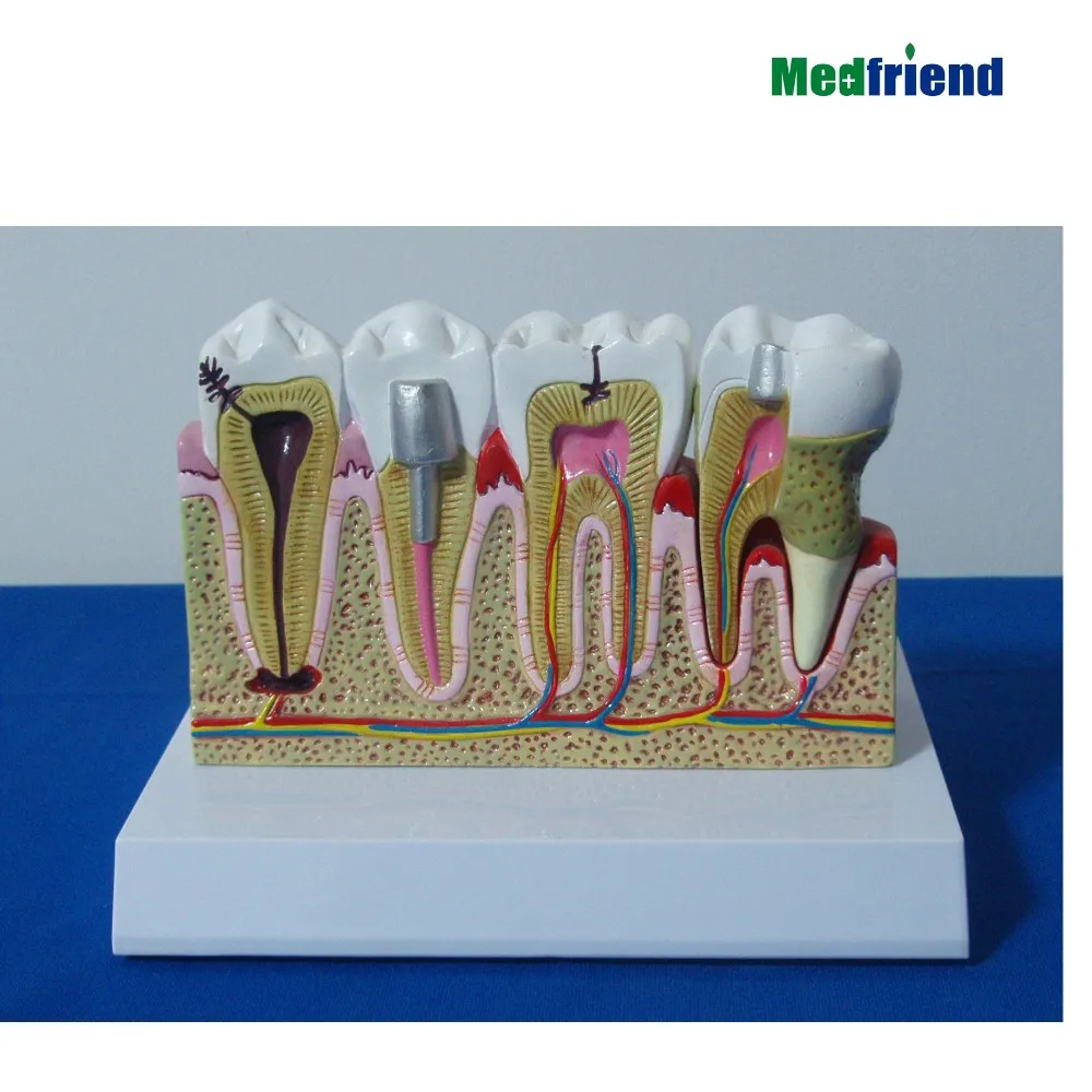 医学科学  产品描述 产品名称: 医用超大膨胀磨牙和前磨牙模型 描述