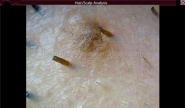 Skin follicle detector7