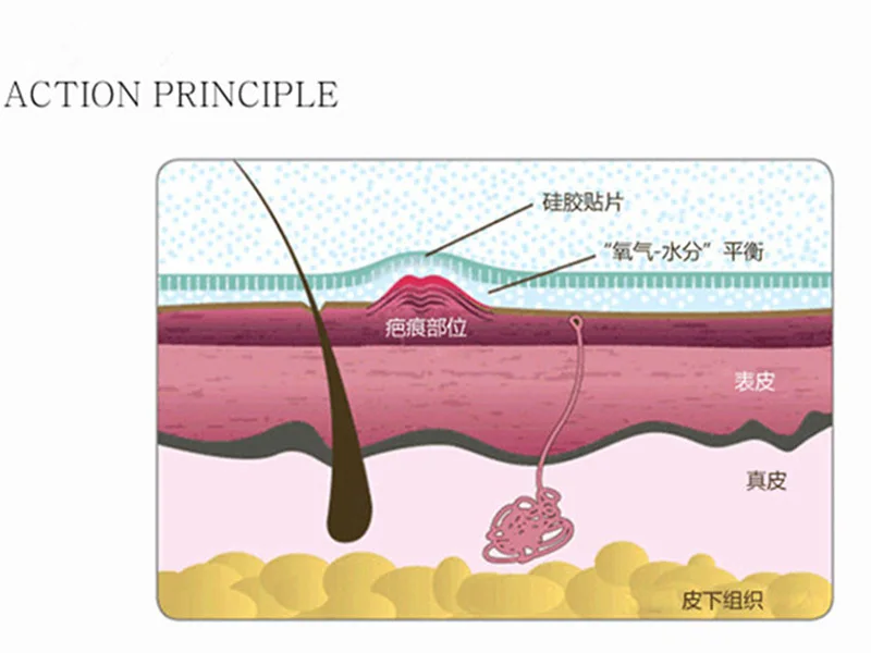Online Products Health Care Products Silicone Scar Tape New Product Mark Patch Scar Removal Silicone Scar Sheet