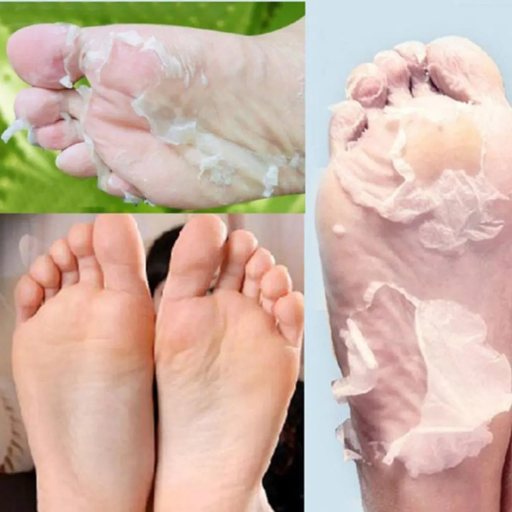 dry feet peeling treatment