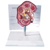 Life size pathological kidney model
