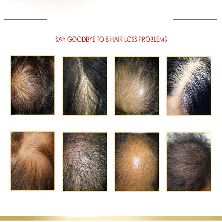 hair loss serum