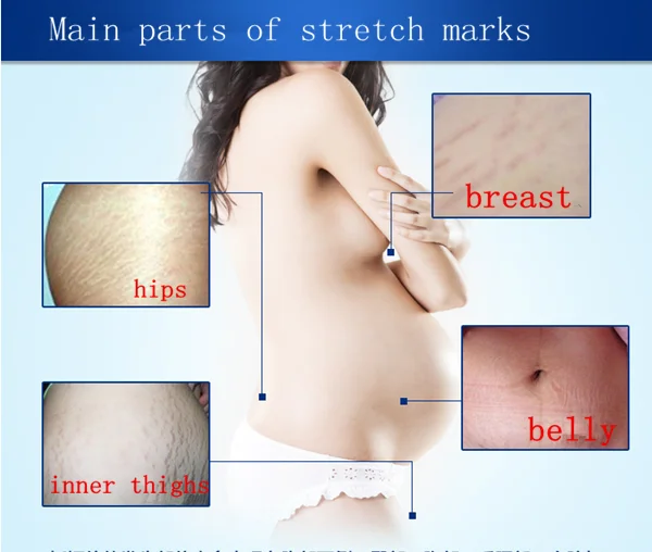 postpartum stretch mark removal