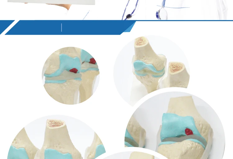 4 Stage Osteoarthritis Knee Model - Educational Tool