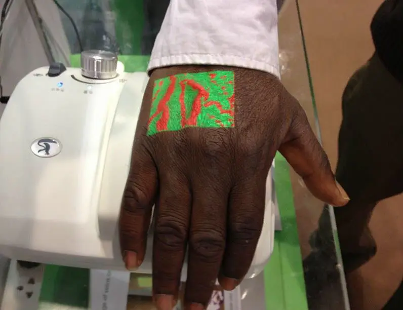 New Blood Vessel Illumination Set for Injection