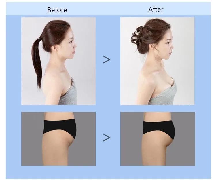 500ml hyaluronic acid buttock injection for surgery