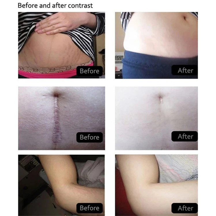 Scars removing and stretch marks removing cream.jpg