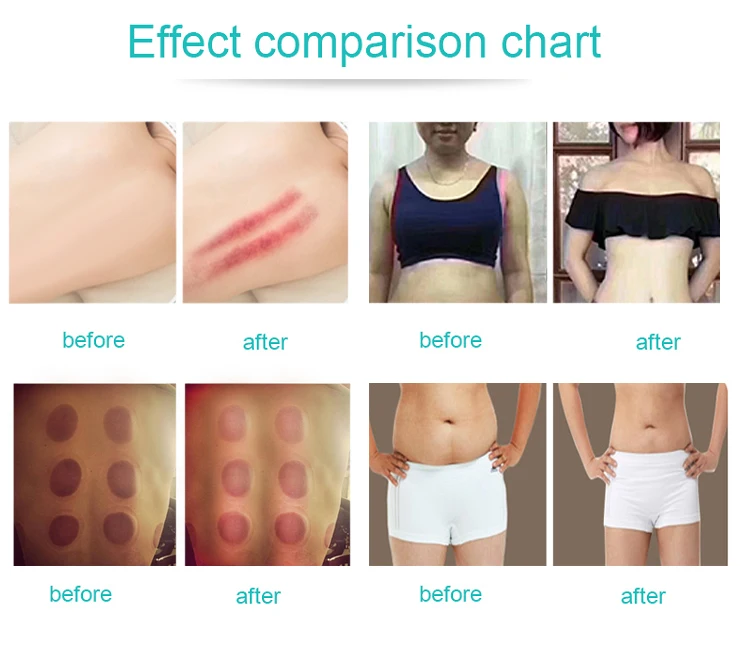 40k Cavitation Fat Burning Cellulite Removal Body Sculpture Contouring Rf Vacuum Shaping Slimming Face Lifting Machine