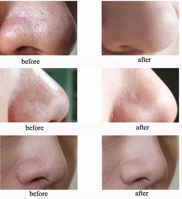 blackhead  (2)