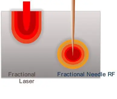  Skin Tightening - Buy Skin Tightening,Rf Skin Tightening,Portable Rf