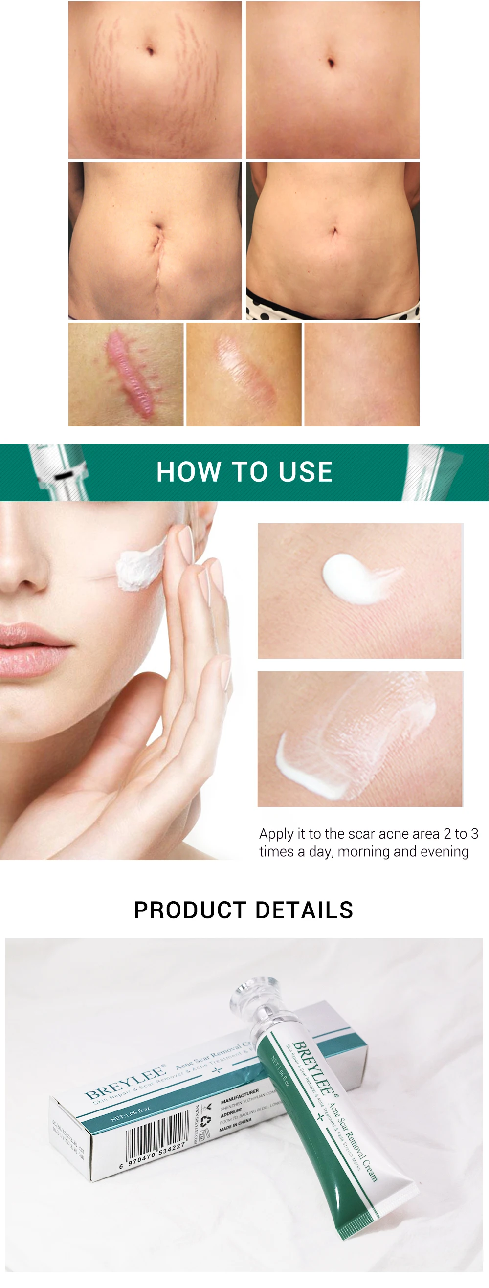 instant acne removal cream