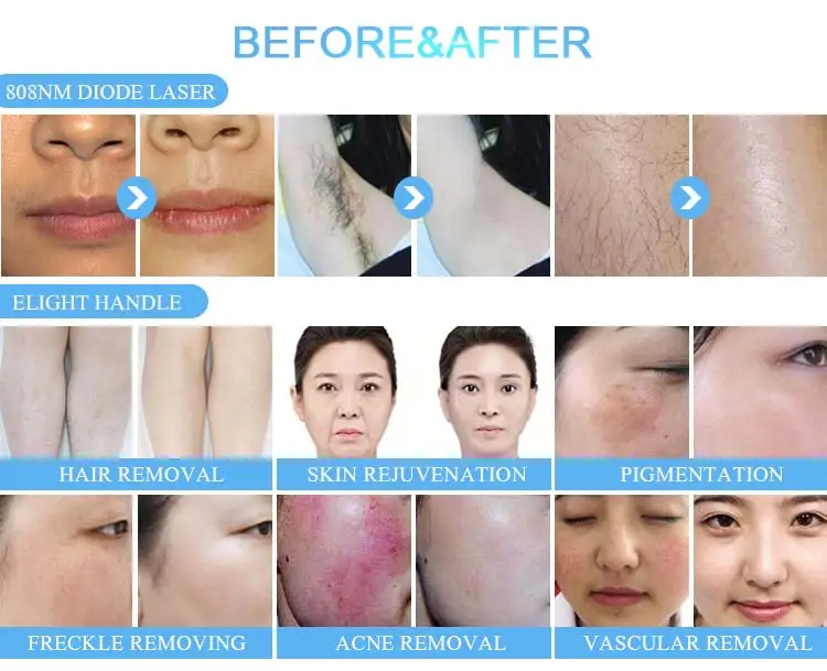 Freckle Wrinkle Acne Hair Removal Machine Ipl Buy Machine Ipl,Machine