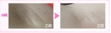 ipl hair removal beauty equipment new product.png