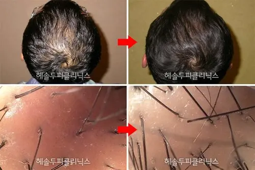 Hair Loss Regrow Herbal Shampoo Buy Hair Regrow Hair Regrow