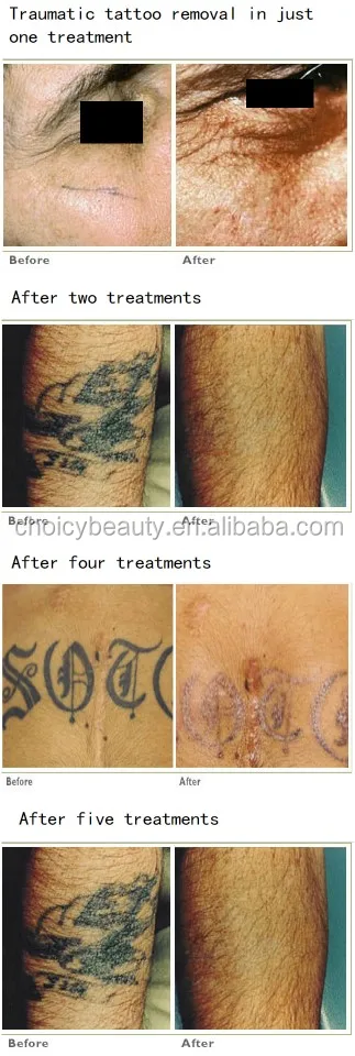 medical q switch nd yag laser spectra laser for tattoo removal medical q switch nd yag laser spectra laser for tattoo removal