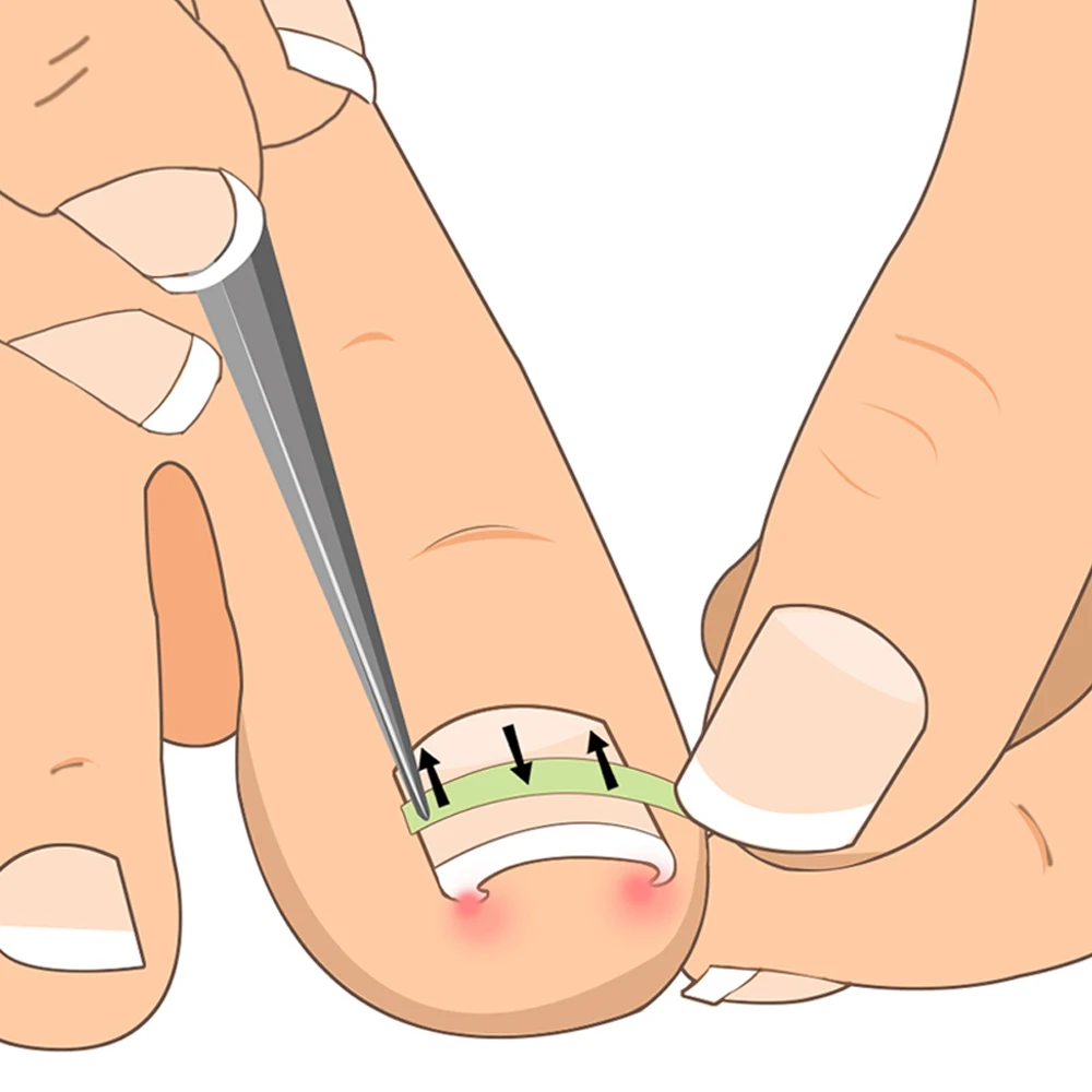 4 StüCk Zehen Nagel Knipser Dicke und Eingewachsene Zehen Nagel Knipser fü V4M2 