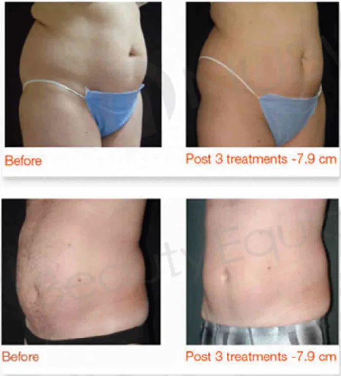 Liposonix отзывы