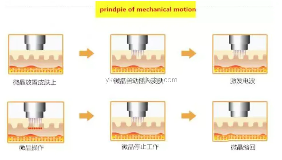 rf fractional micro needle.png