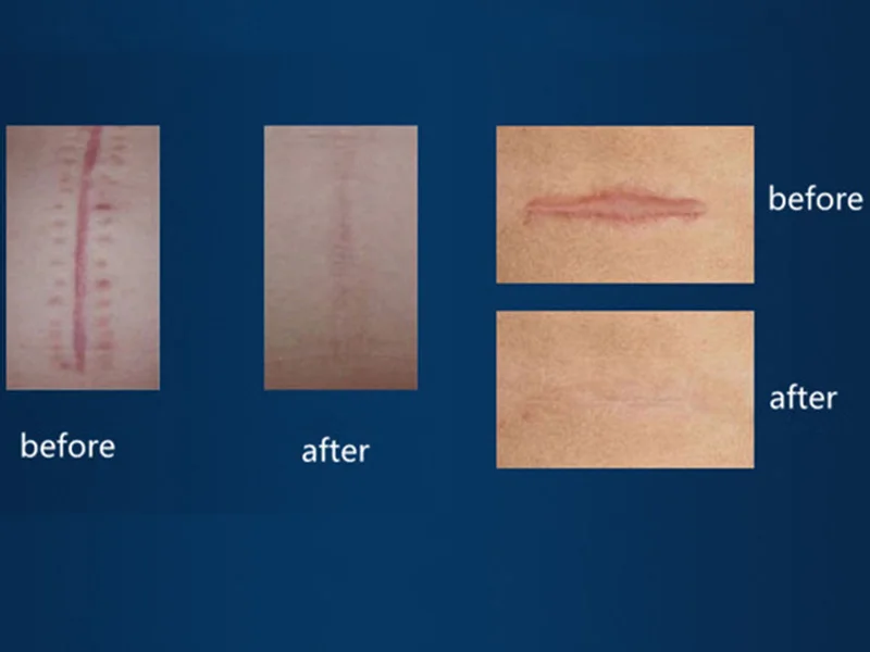 Online Products Health Care Products Silicone Scar Tape New Product Mark Patch Scar Removal Silicone Scar Sheet