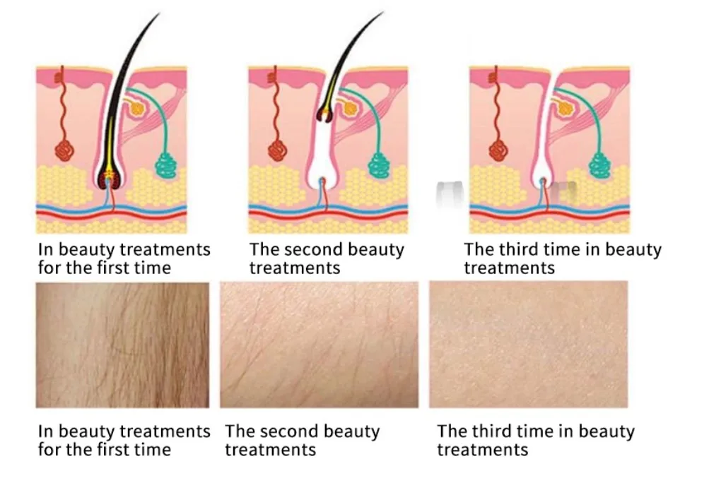 opt ipl rf nd yag best laser hair removal and skin rejuvenation machine magneto optic