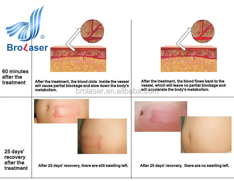 ice Fat Slimming Machine