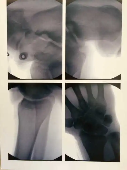 LCD Low-Intensity Portable X-Ray Imaging Scope