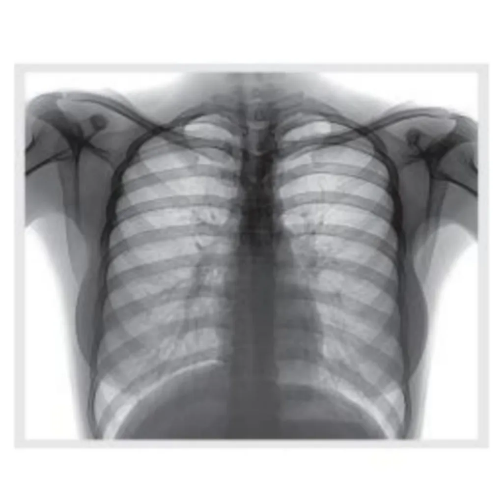 Темное пятно на рентгене легких. Темное пятно на легком что это. Темное пятно на легком что это. Рентген легких. Темное пятно на легком что это.