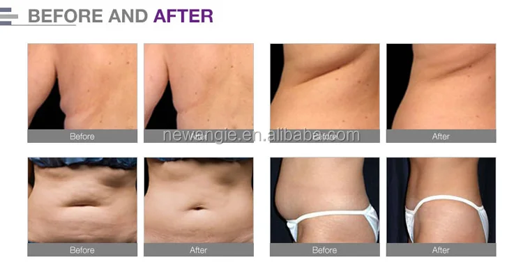 Cryo lipo lase (3).jpg